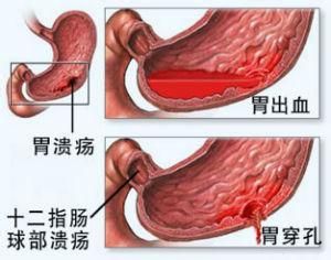 潰瘍病