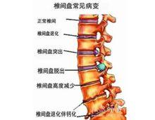 椎間盤病症圖