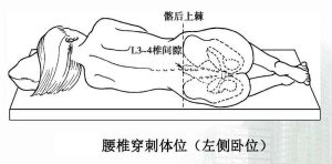 鞘內注射