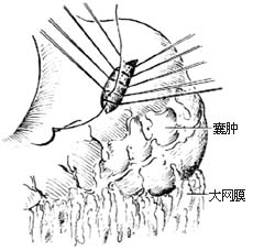 胰腺假性囊腫