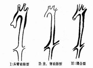 多發性大動脈炎