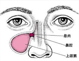 青少年鼻竇炎