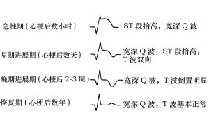 t波