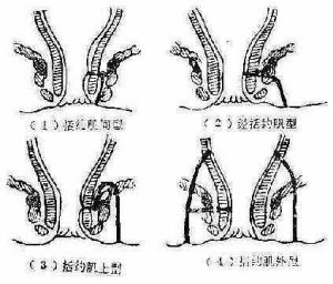 肛門瘺管