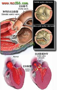 先天性主動脈瓣下狹窄