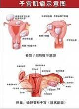 子宮肌瘤圖冊