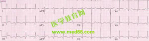 《急性心肌梗死的心電圖診斷》