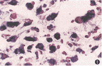 （圖）膠質母細胞瘤細胞