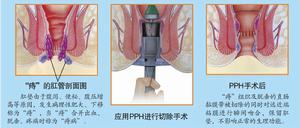 肛泰療法