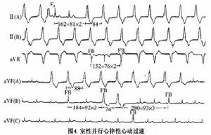 室性並行心律及室性並行心律性心動過速