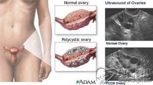 多卵巢綜合症