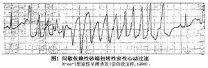 間歇依賴型尖端扭轉型室性心動過速