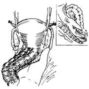 缺血性腸絞痛