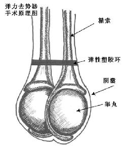 彈力去勢器手術原理圖