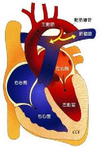 妊娠合併心室間隔缺損