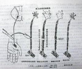 周圍神經損傷康復