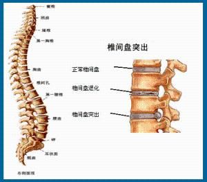 腰椎間盤滑脫