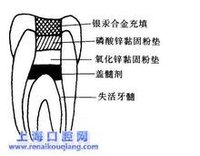 活髓切斷術規範步驟