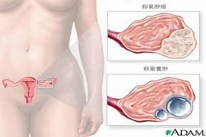 卵巢過度刺激綜合症