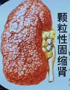 顆粒性固縮腎