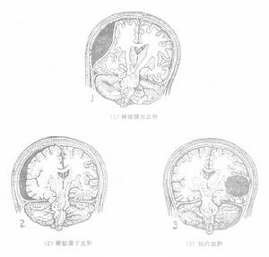 開放性腦損傷