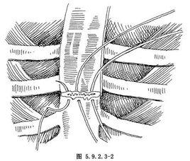 胸骨骨折內固定術