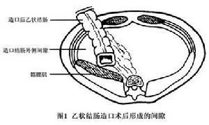 乙狀結腸造口旁溝疝