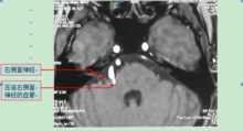 核磁顯示右側面神經在出腦幹處被一血管壓迫