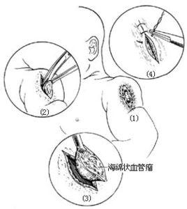 毛細血管瘤和海綿狀血管瘤切除術