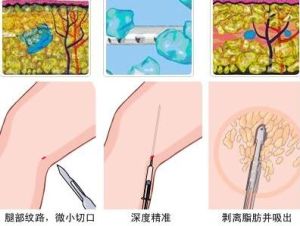 手術過程