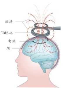 經顱磁刺激技術