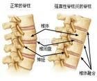 強直性胸椎炎