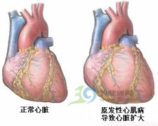 原發性心肌病