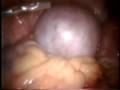 卵巢良性腫瘤