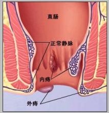 血栓外痔