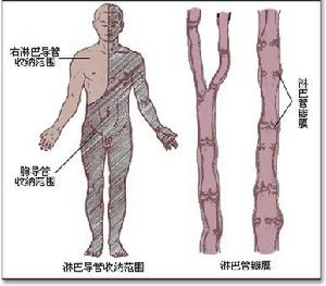 下肢淋巴水腫