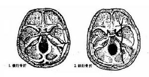 （圖）顳骨骨折
