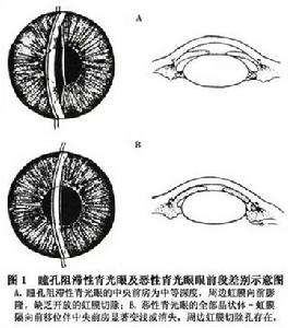 睫狀環阻滯性青光眼