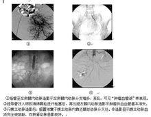 骨盆腫瘤