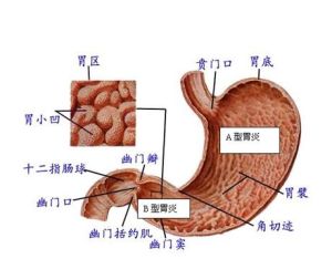 腸胃炎