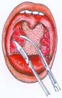 《扁桃體剝離術》