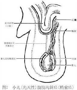 小兒腹股溝斜疝