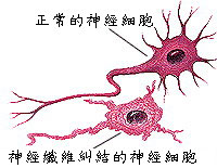 愛羅斯·阿茲海默