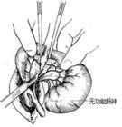 先天性腸閉鎖與狹窄