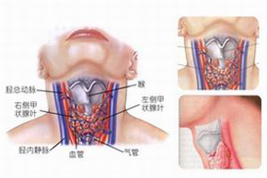 老年甲亢