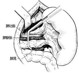 脾機能亢進症