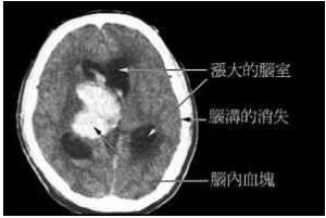 水腦症