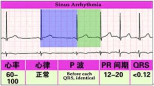 竇性心律不齊