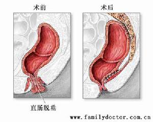 放射性腸炎