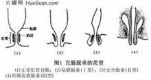 直腸糜爛示意圖